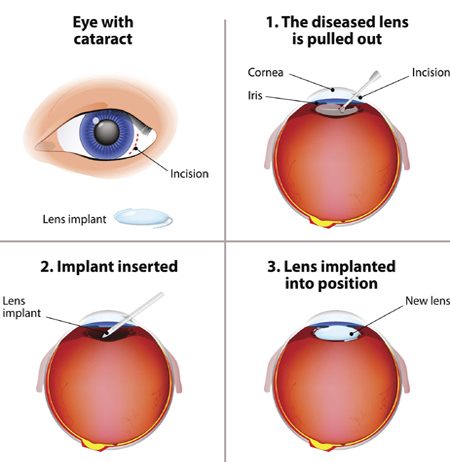 Purang Eye Centre New Delhi