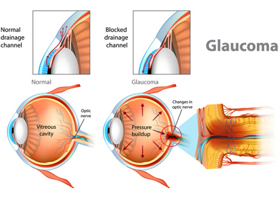 Purang Eye Centre New Delhi