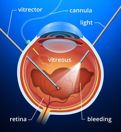 Purang Eye Centre New Delhi